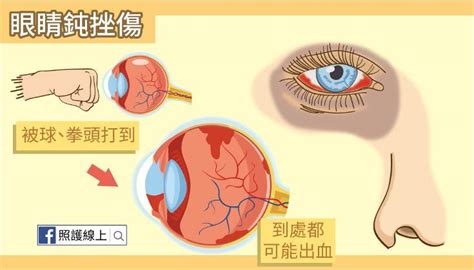 夢到別人眼睛受傷|夢到眼睛受傷